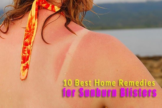Home Remedies for Sunburn Blisters