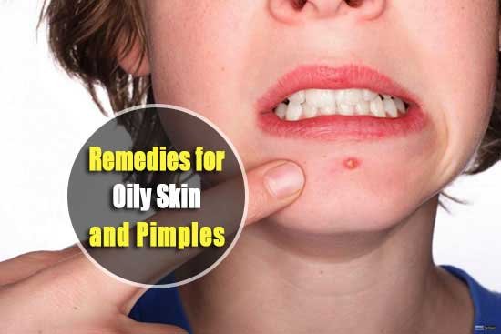 Home Remedies for Oily Skin and Pimples